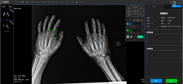 Xray image of hand that shows bone fracture location